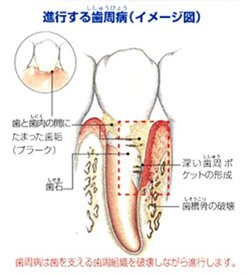 periodontal_image03