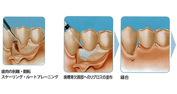 periodontal_image08